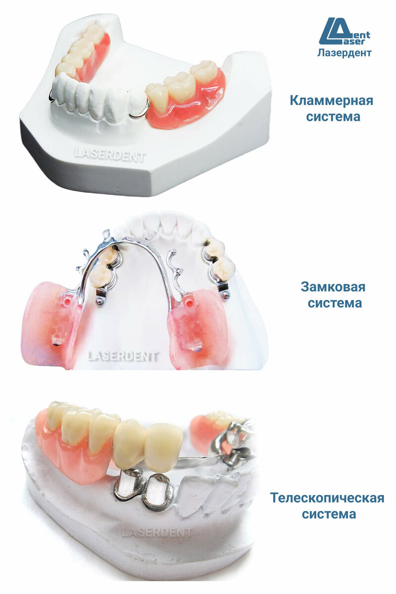 Бюгельный Протез Зубов на Верхнюю и Нижнюю Челюсть. Цена