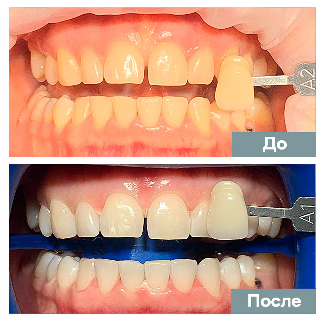 Сделать белые зубы в стоматологии