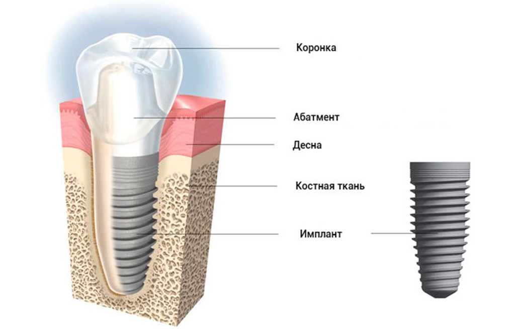 Схема имплантации зубов в картинках