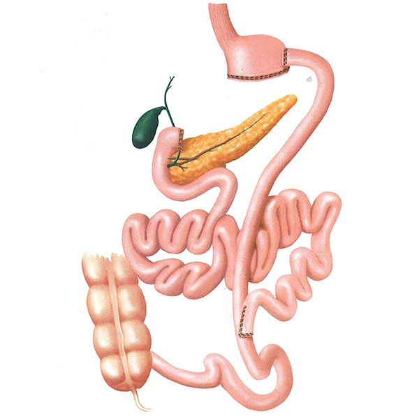 Шунтирование желудка. Билиопанкреатическое шунтирование желудка что это. Билиопанкреатическое шунтирование (отведение). Лапароскопическое желудочное шунтирование. Лапароскопическое билиопанкреатическое шунтирование.