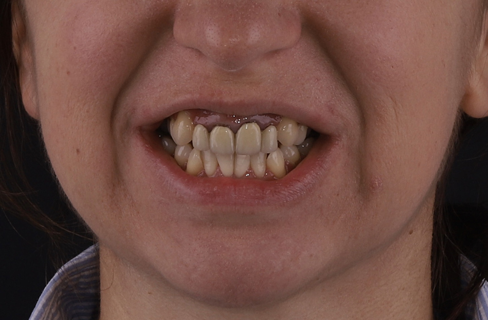 Исправление неправильного прикуса и замена устаревших реставраций для гармоничной улыбки