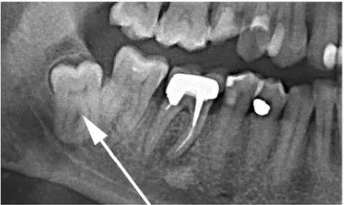 атипичное положение зуба мудрости