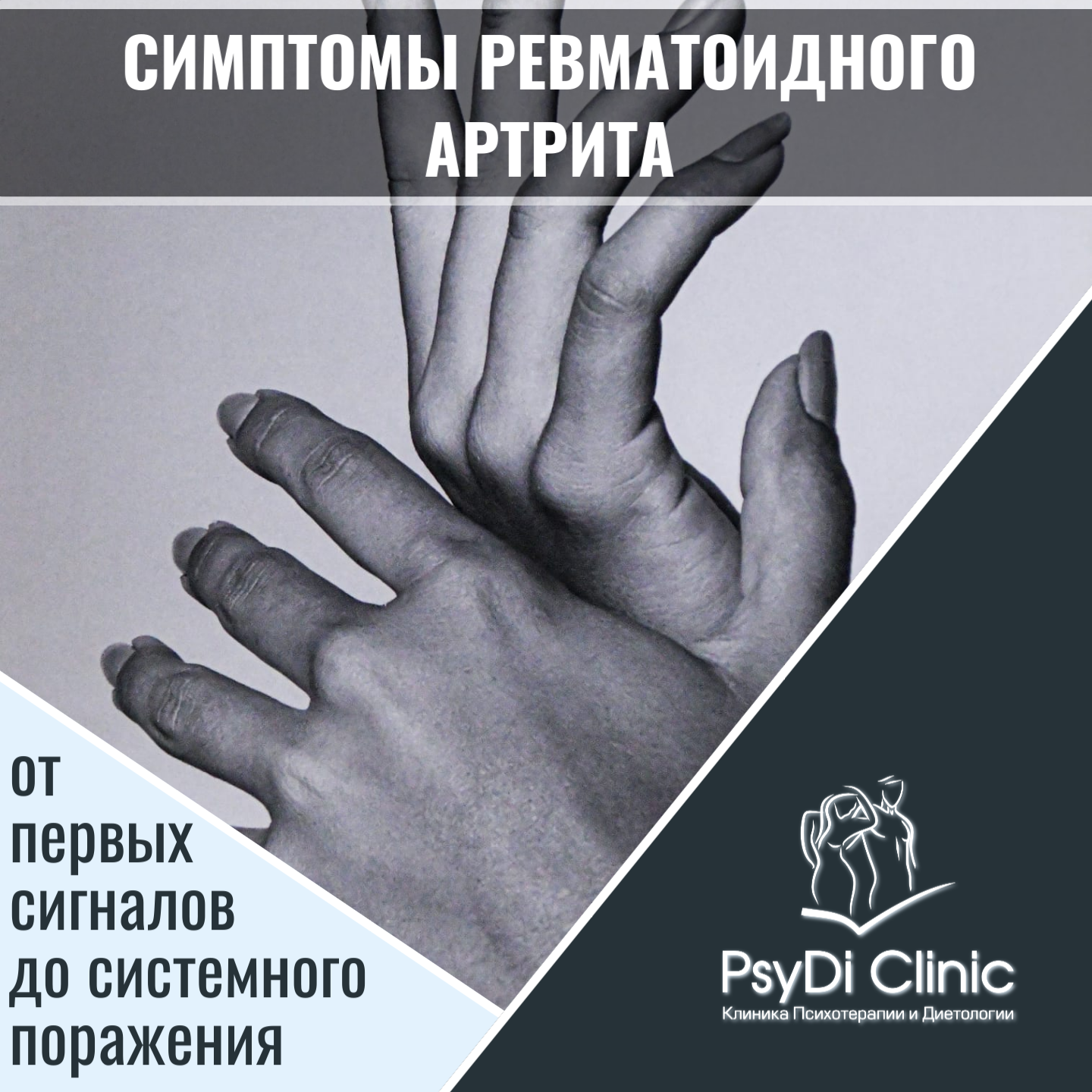 Симптомы ревматоидного артрита: от первых сигналов до системного поражения