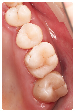 Профессиональное лечение зубов в Луганске, стоматология Дент-Арт