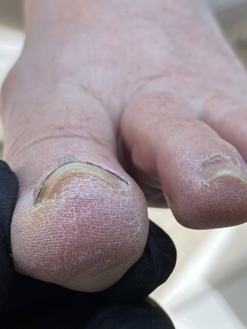 скобы +для вросшего ногтя, скобы +на ногти +для выпрямления