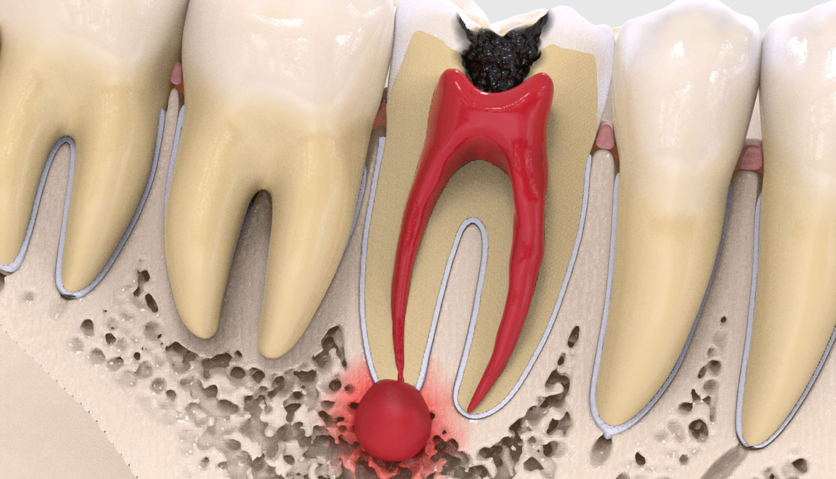 Гранулема зуба: причины образования, диагностика, лечение