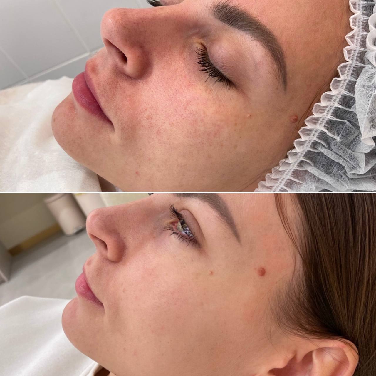 ДО и ПОСЛЕ процедуры Фототерапии
