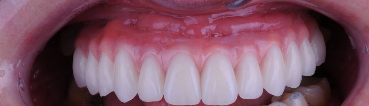 Перепротезирование верхней челюсти по протоколу 