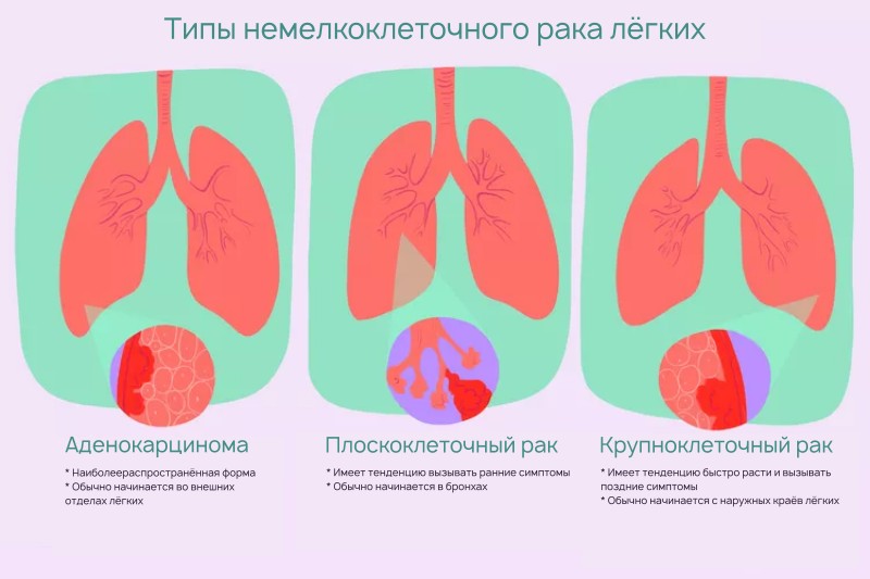 Рак лёгких: виды, симптомы, диагностика и методы лечения опухоли в лёгких