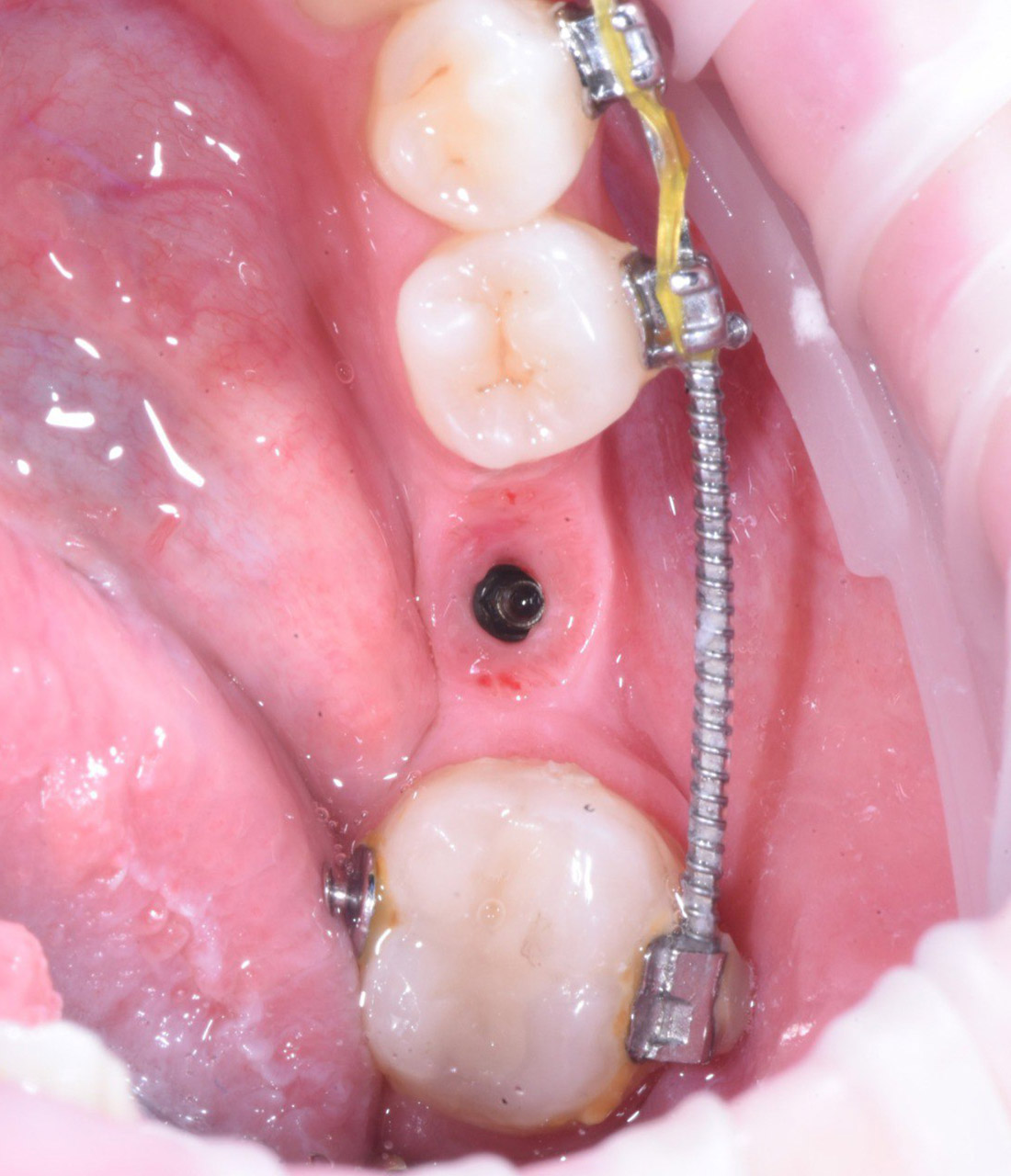 Восстановление зубного ряда через протезирование циркониевой коронкой на импланте Osstem