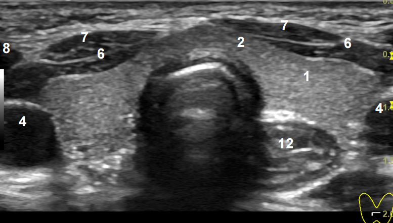 Ультразвуковая анатомия щитовидной железы. Коллоидная гиперплазия щитовидной железы УЗИ. Лимфатический узел щитовидной железы УЗИ.