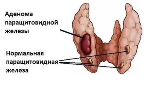 Диагностика аденомы печени