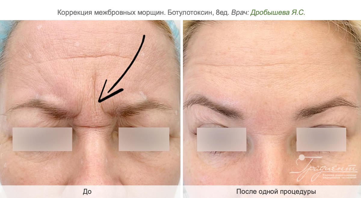 Коррекция межбровных морщин в клинике косметологии «Градиент» в Москве