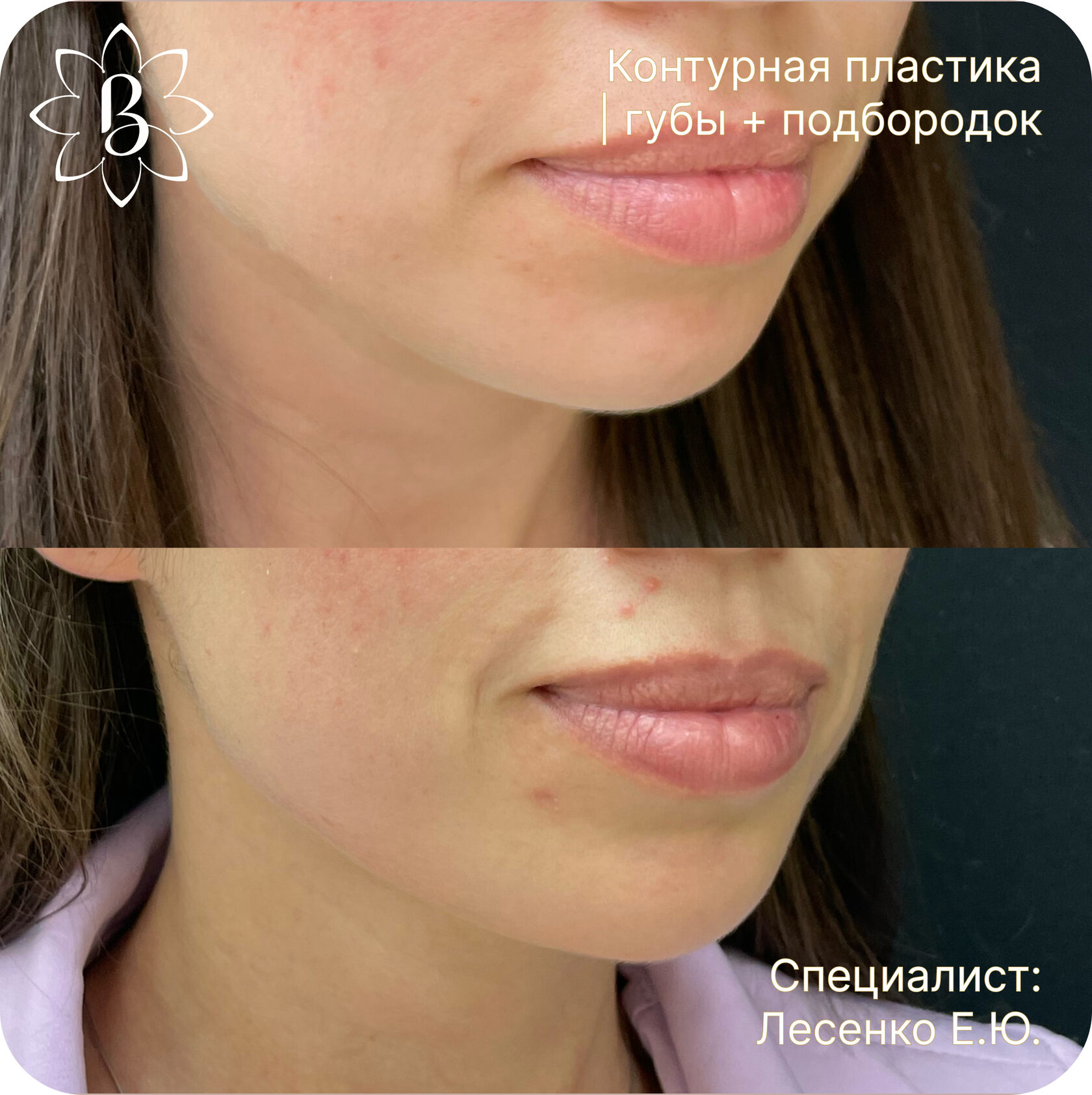 Александритовая лазерная эпиляция