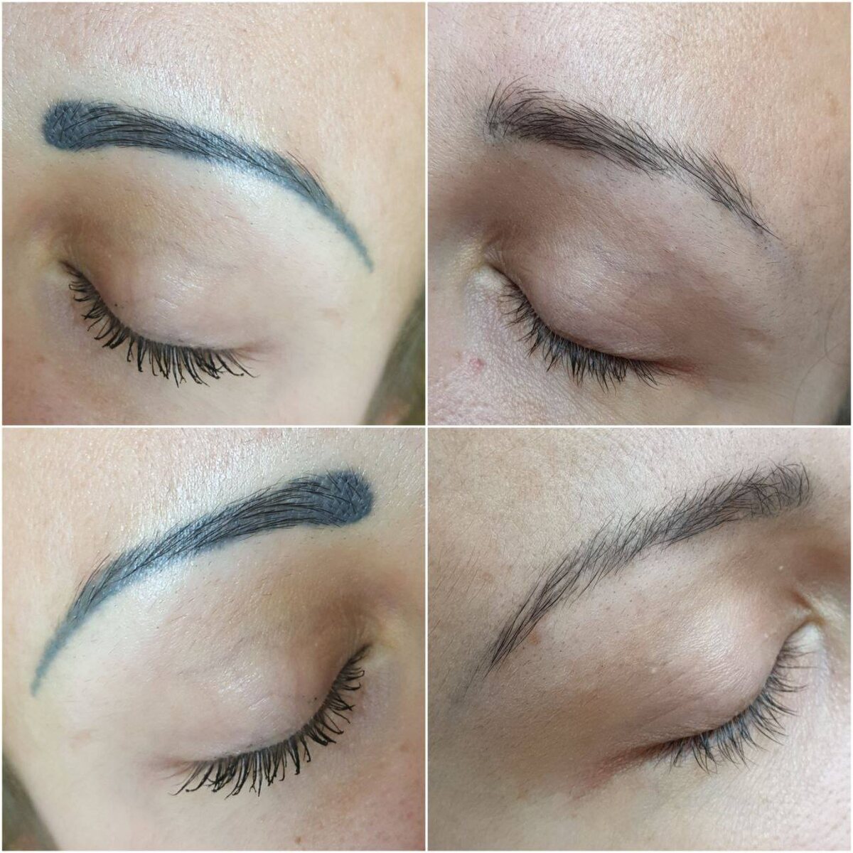 Лазер или ремувер?