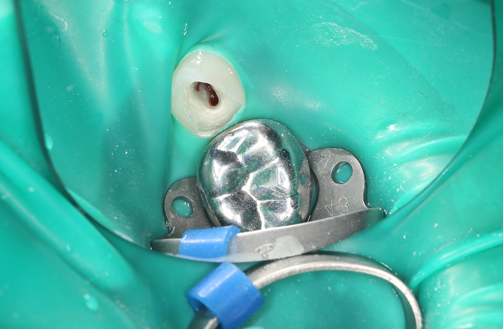 Защита ослабленного молочного зуба металлической коронкой после эндодонтического лечения