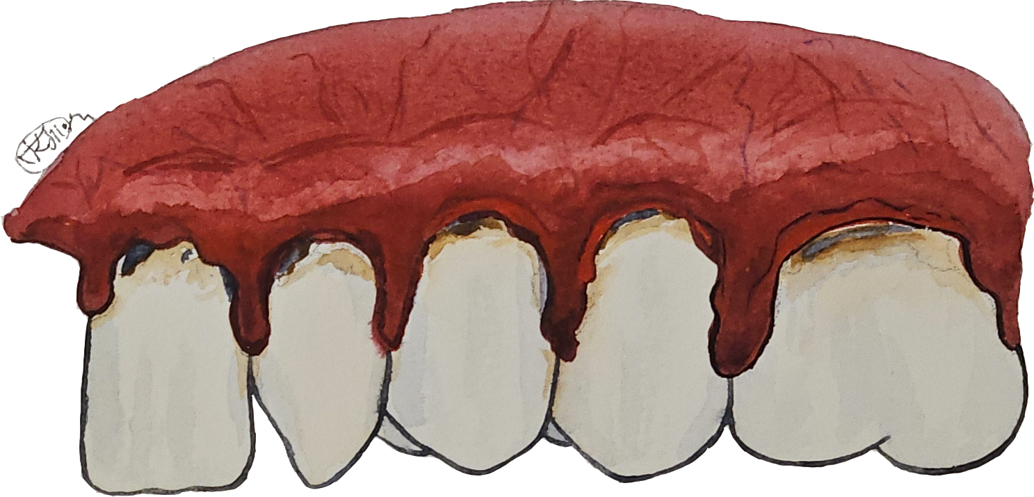 Пародонтит воспаление десны