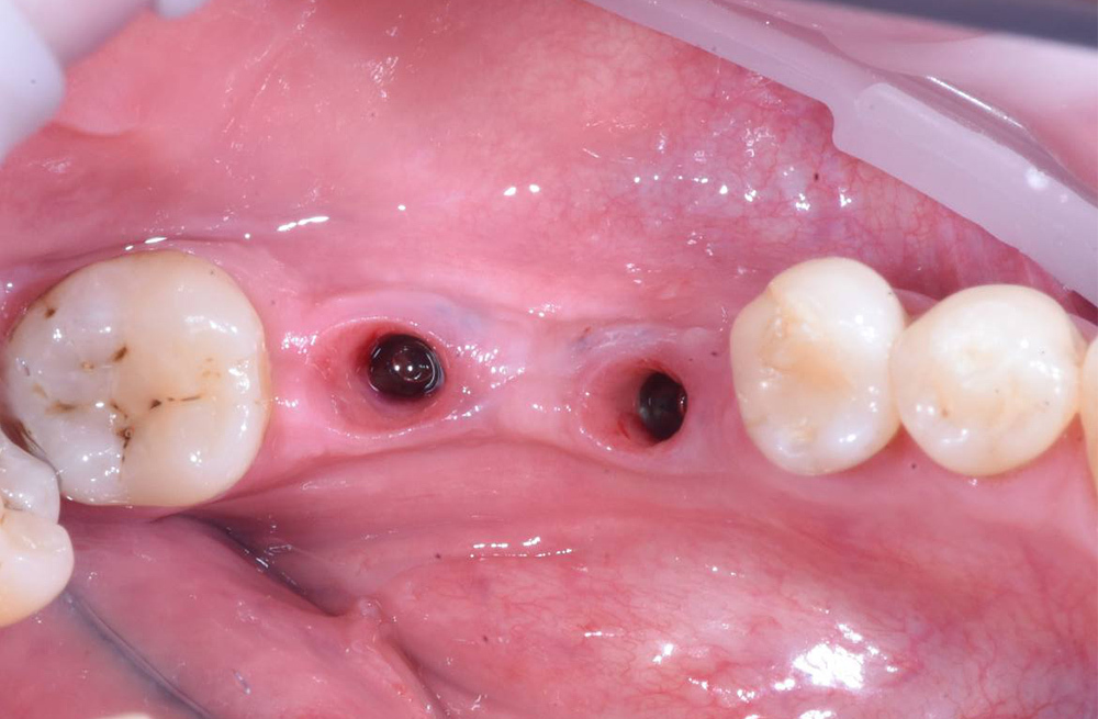 Восстановление жевательной группы зубов имплантацией Osstem и протезированием цирконием