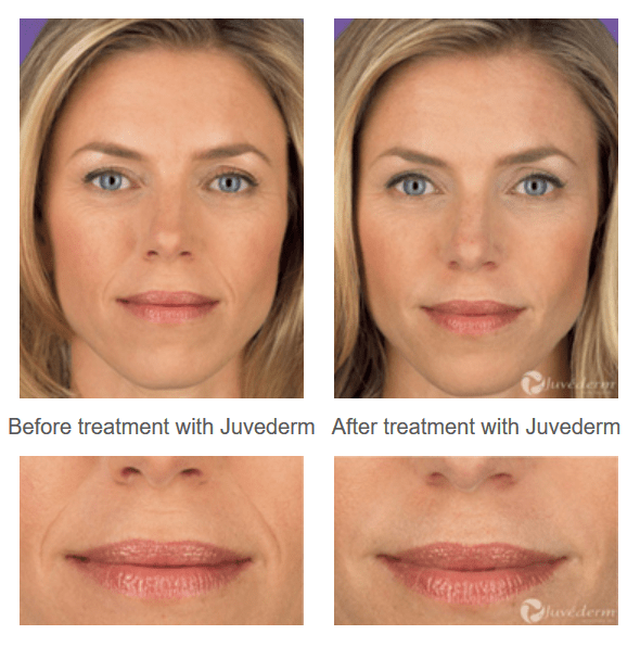 Увеличение отзывы. Филлер Juvederm. Ювидерм Волбелла до и после. Филлер для губ Ювидерм Смайл.