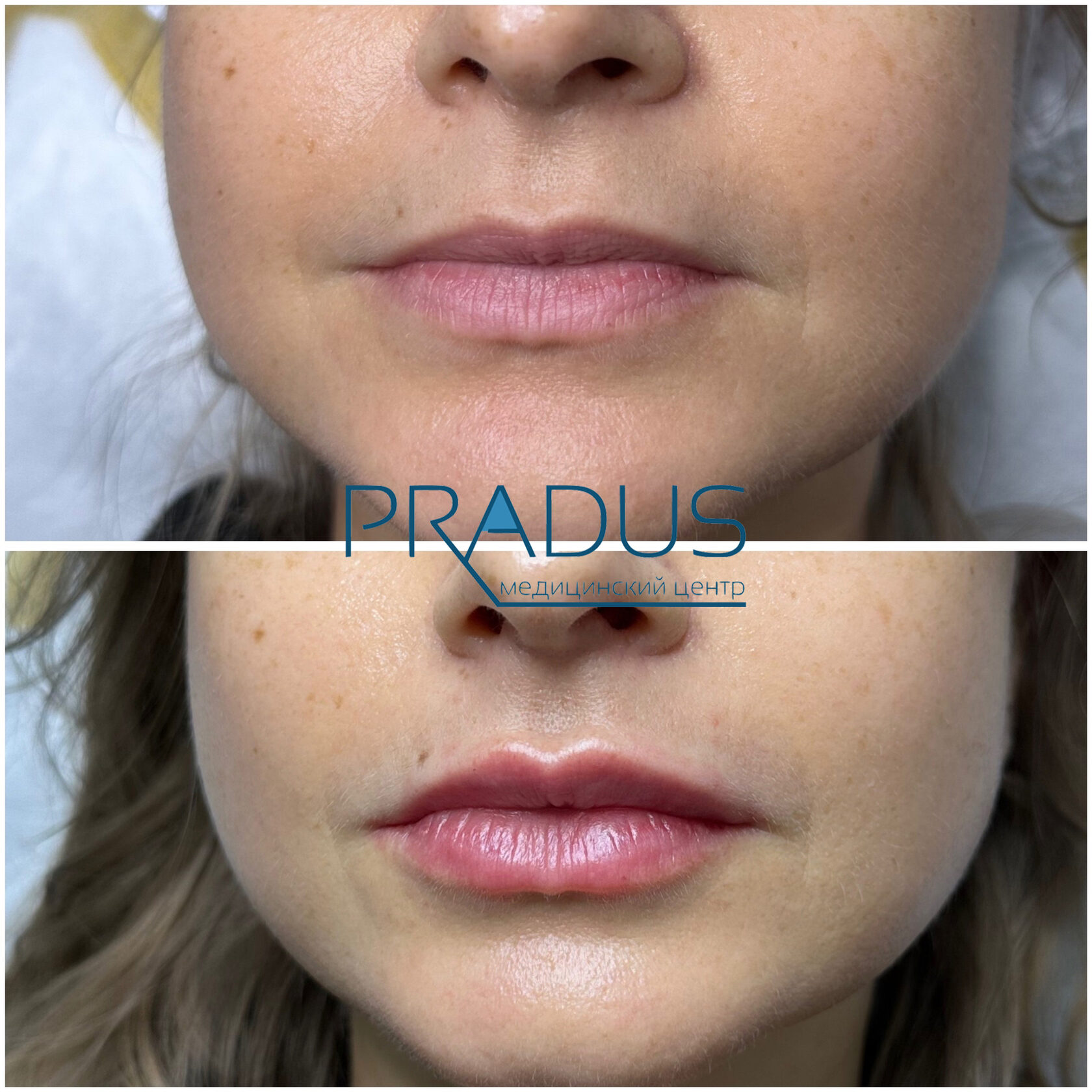 До и после контурной пластики губ. Увеличение объёма без утяжеления. PradusCOSMO, Васильевский остров