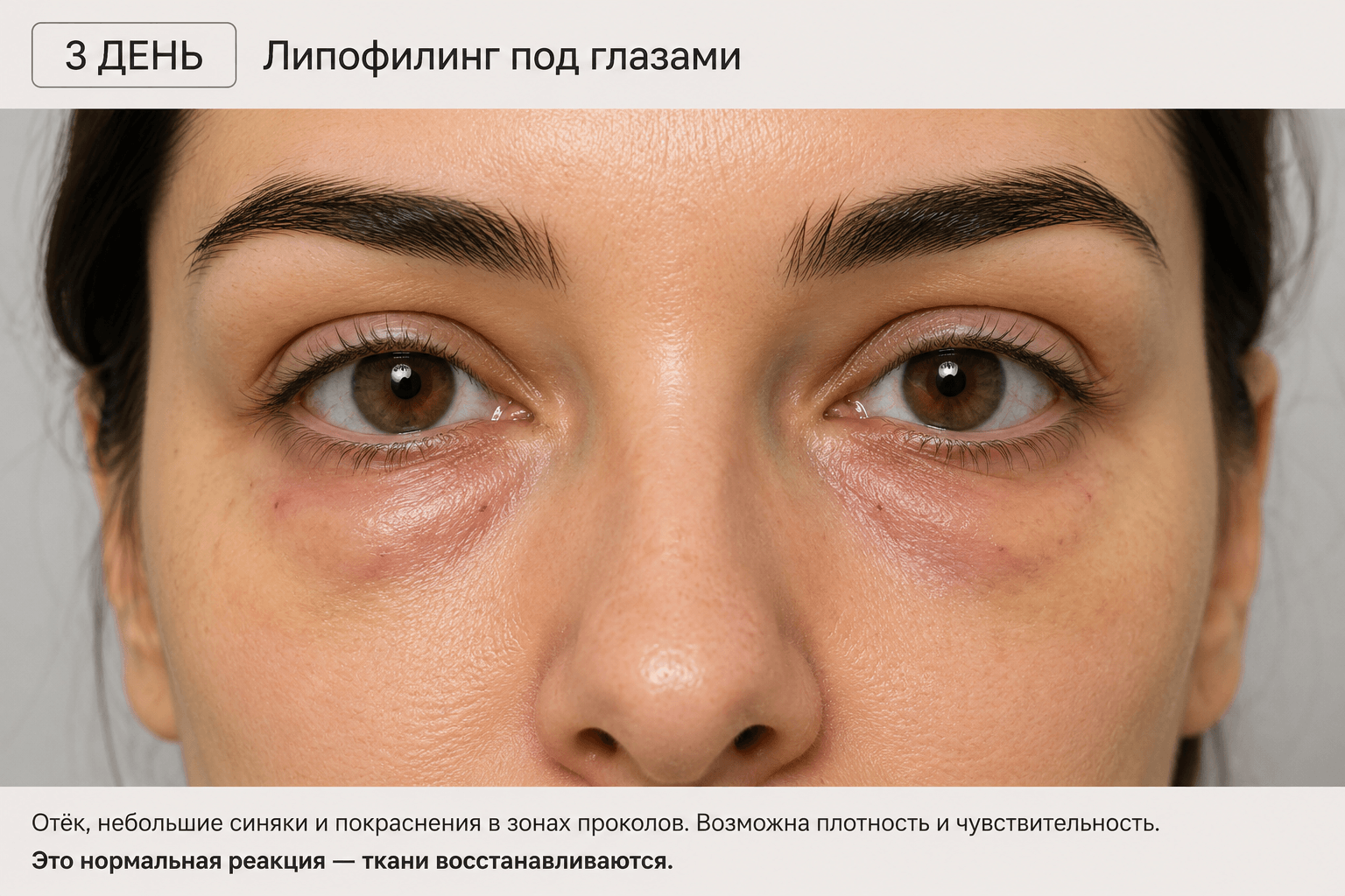 3-й день после липофилинга под глазами