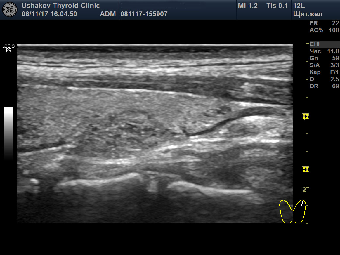 Ультразвуковое исследование паращитовидной железы. Паращитовидные железы на УЗИ. Аденома паращитовидной железы на УЗИ. Паращитовидные железы анатомия на УЗИ. Гиперплазия паращитовидной железы на УЗИ.