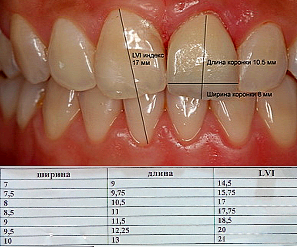 Индекс болтона. LVI индекс стоматология. Длина и ширина резцов зубы.