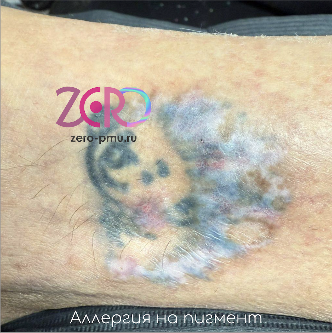 Аллергия на татуировку. Что делать? - zero-pmu.ru