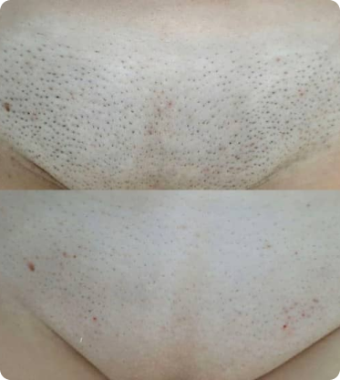 Лазерная эпиляция 