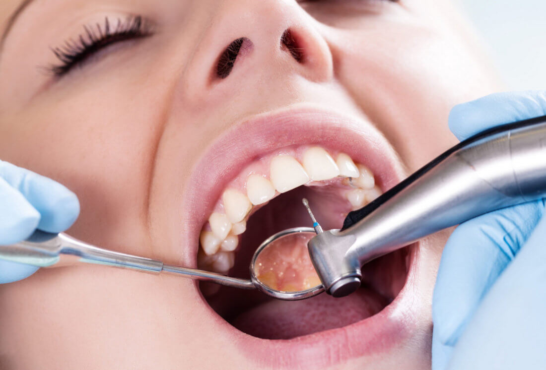 наращивание зуба