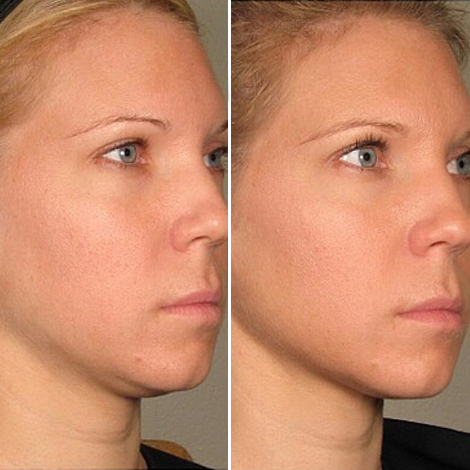 SMAS-лифтинг лица ULTRAFORMER в Новосибирске, цена на SMAS-лифтинг лица ULTRAFOR