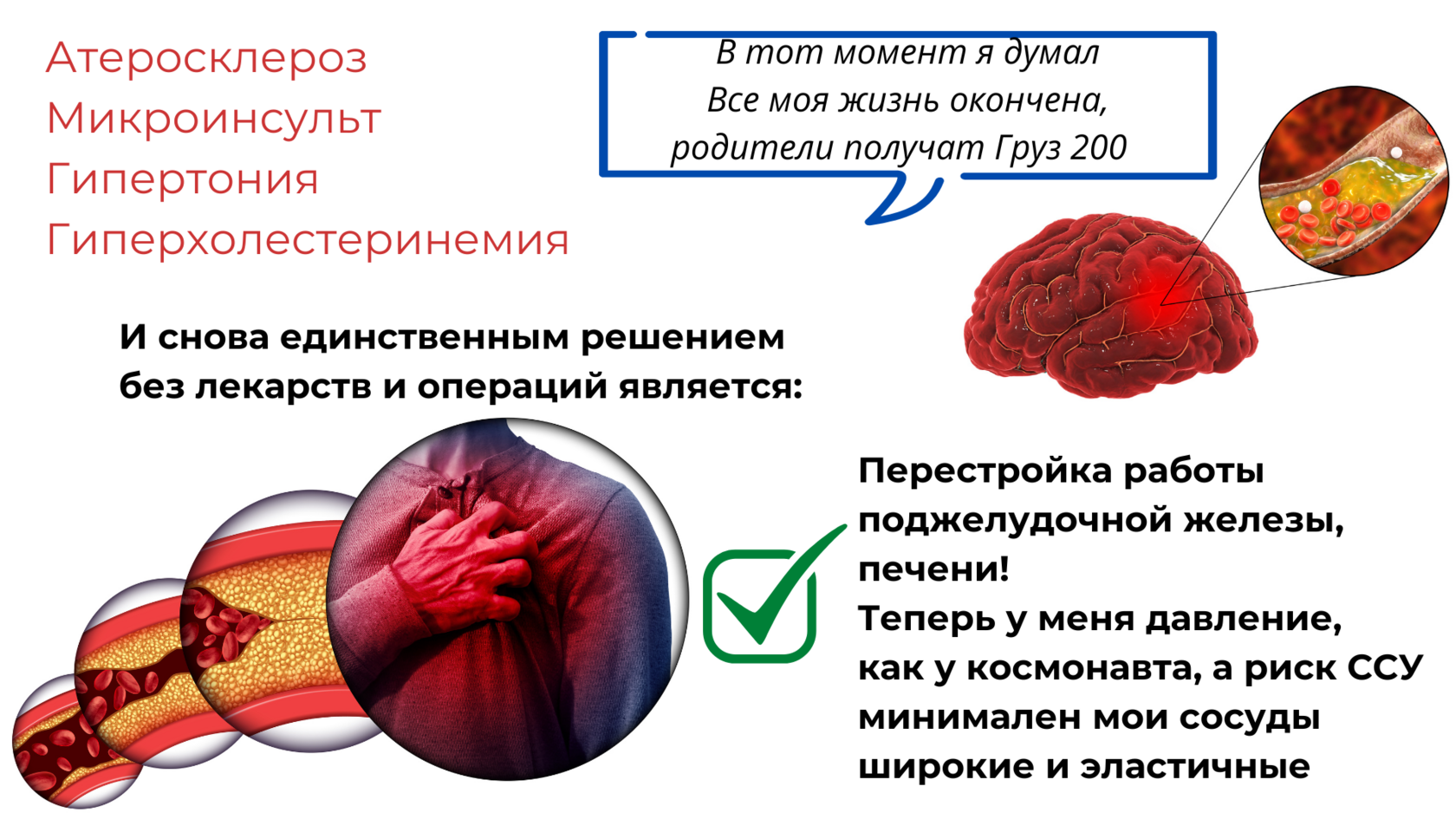 Изображение показывает как происходит инсульт, кроворазжижающее, густая кровь, атеросклероз, бляшки в сосудах, высокий холестерин 