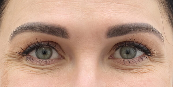 крупный план кожи с разными типами морщин вокруг глаз
