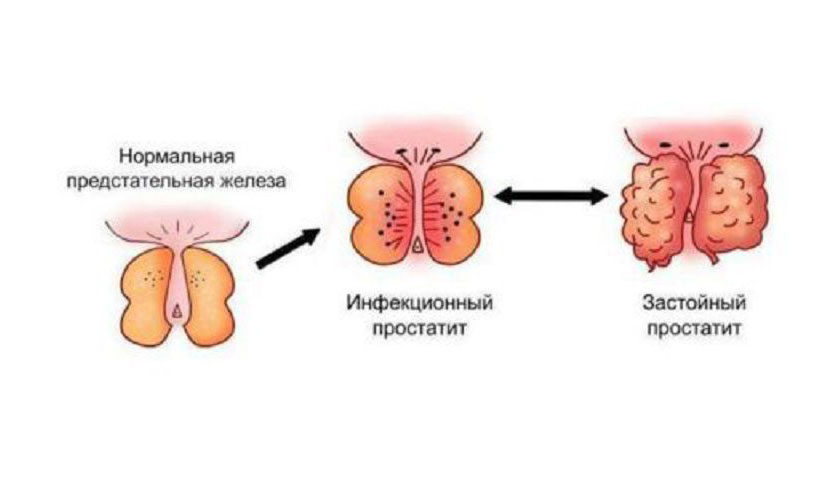 Как быстро снять воспаление предстательной железы