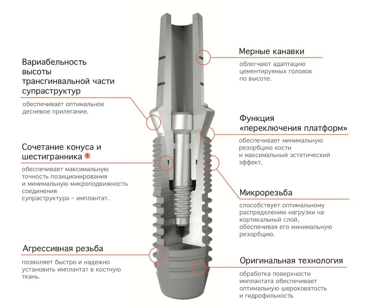 Из чего состоит имплант зуба схема и описание