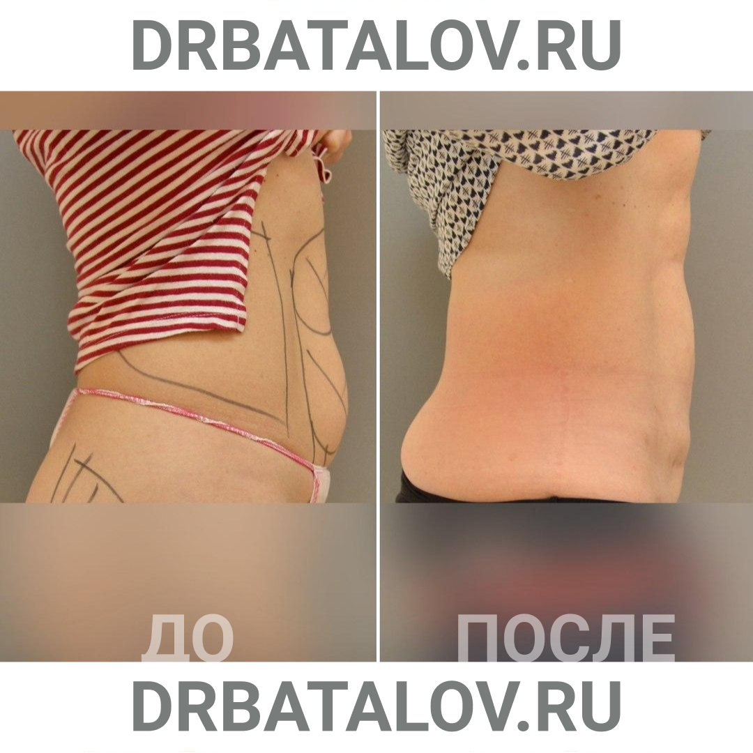 Радиочастотная липосакция Body Tite