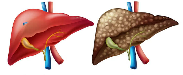 Боли при циррозе печени