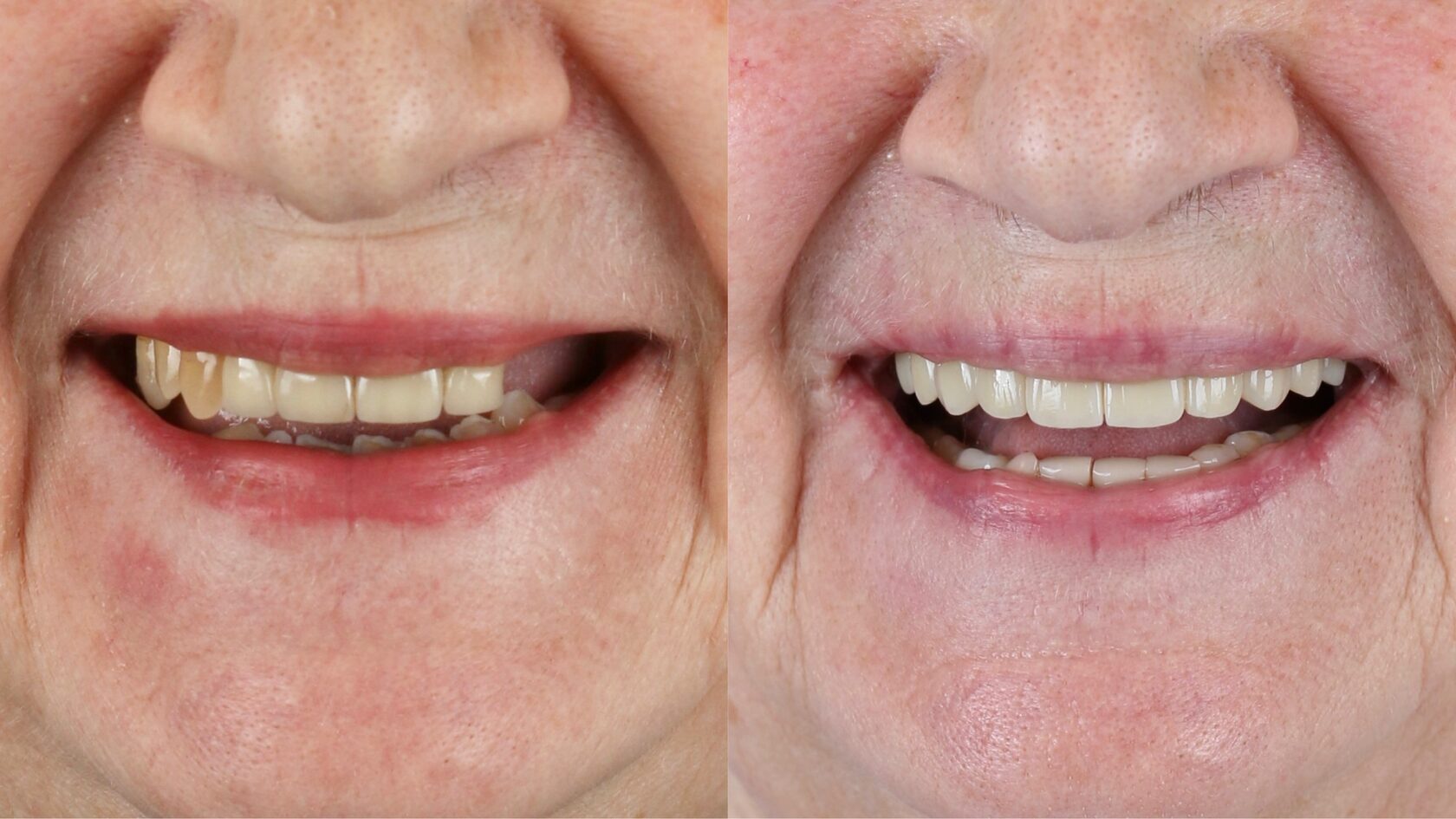 Как сохранить зубы здоровыми после 40, 50 и 60 лет