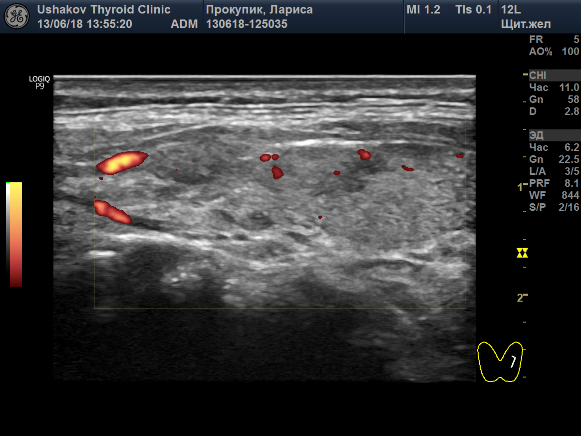 Узи нижних конечностей изранов. Протокол УЗИ щитовидной железы. Эхогенность щитовидная железа на УЗИ. УЗИ протокол щит жел. Гипотиреоз УЗИ протокол.