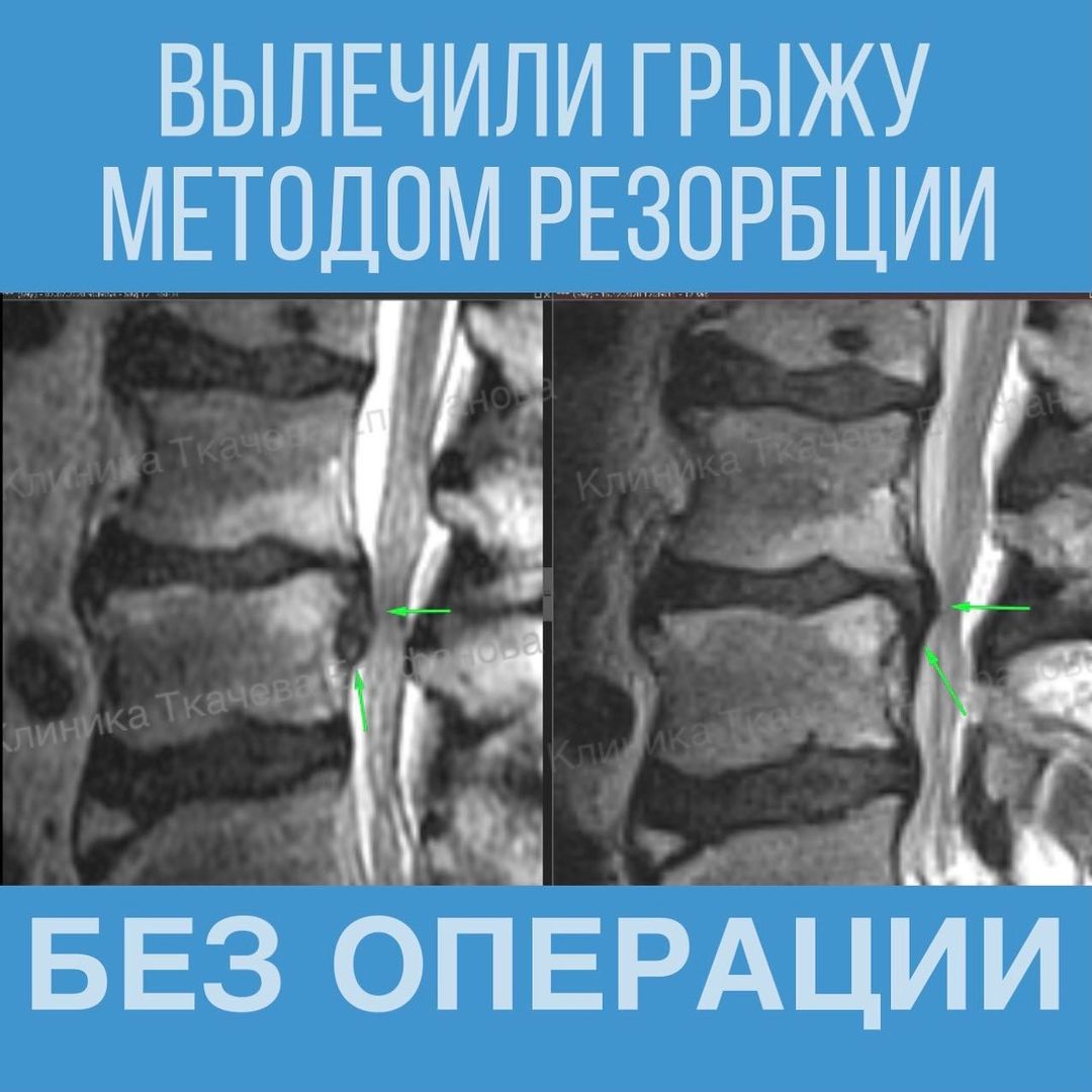 Резорбция грыжи. Резорбция грыжи межпозвонкового диска. Резорбция поясничной грыжи. Клиника Ткачева Епифанова резорбция грыжи.