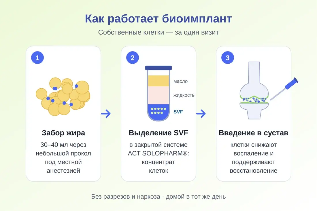 Как работает биоимплант: забор жира, выделение SVF, введение в сустав