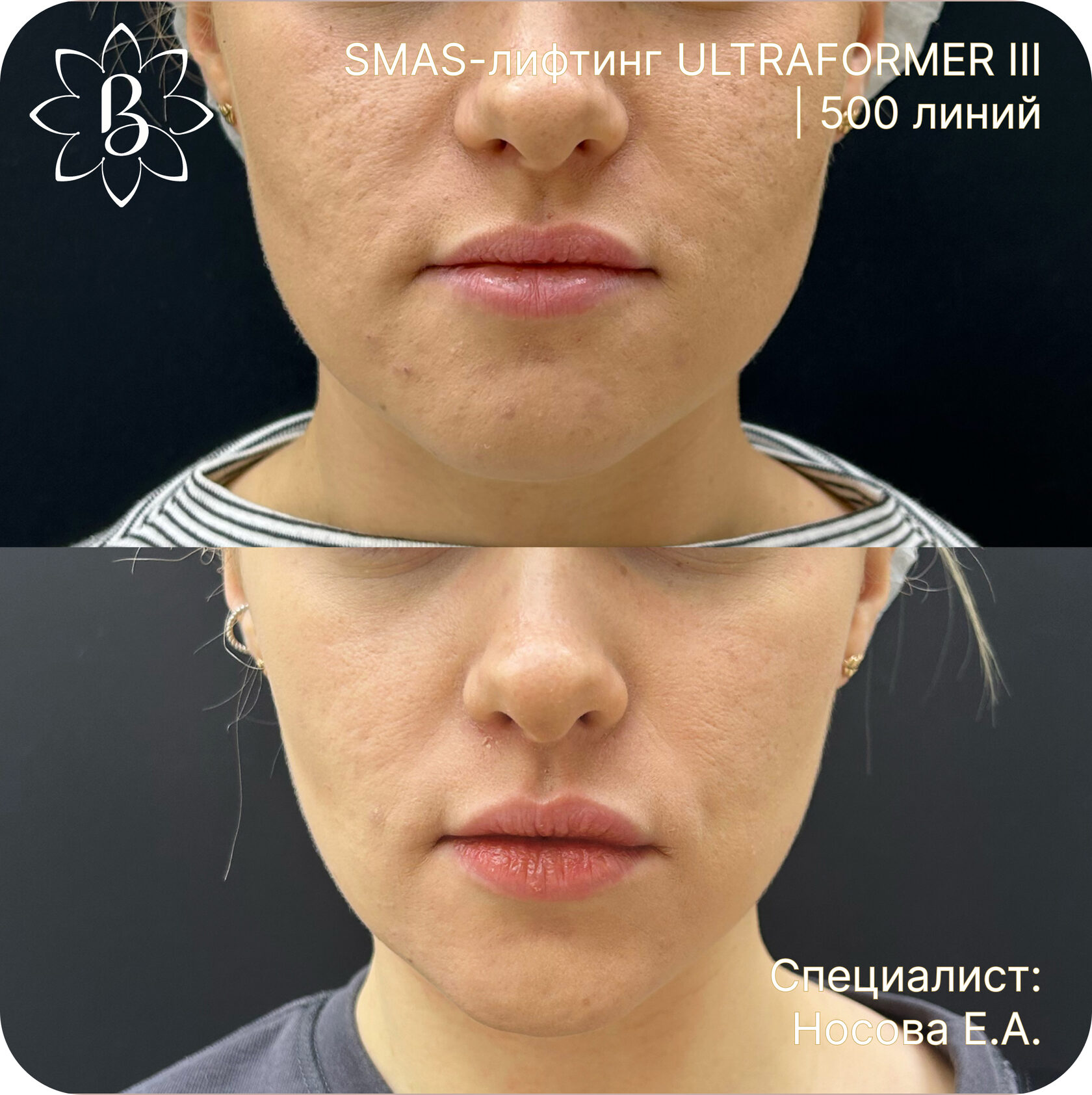 Александритовая лазерная эпиляция СПб