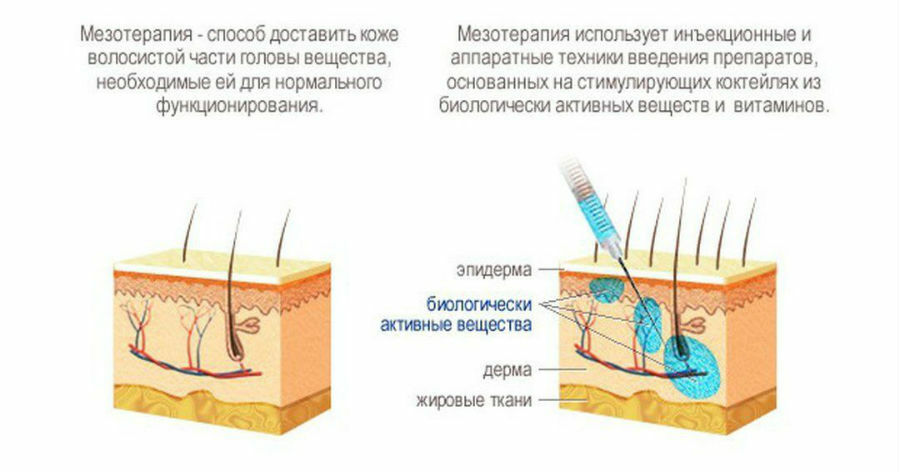 Схема мезотерапии лица