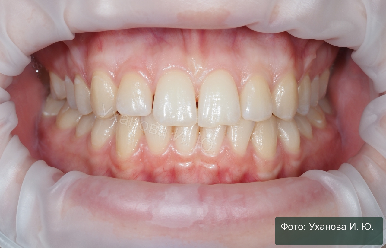 До отбеливания: A1