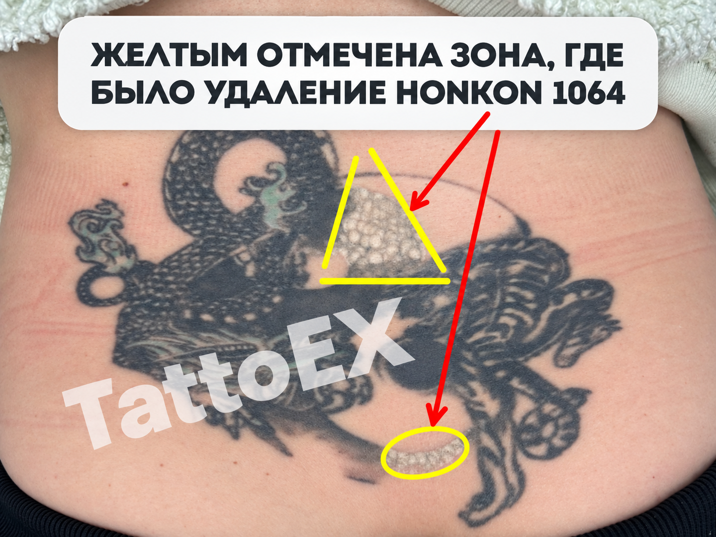 Удаление тату неодимовым лазером — участок после Honkon 1064
