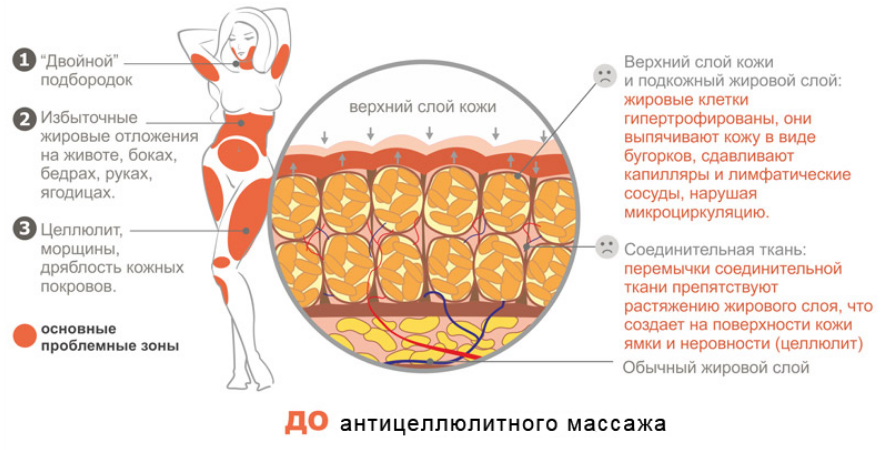 Как убрать жировое отложение. Целлюлит подкожный жир. Целлюлит схема. Что откладывается в жир.