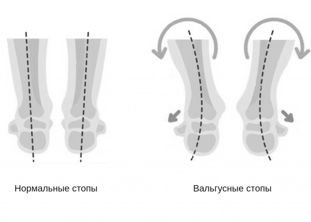 Деформация стопы врач