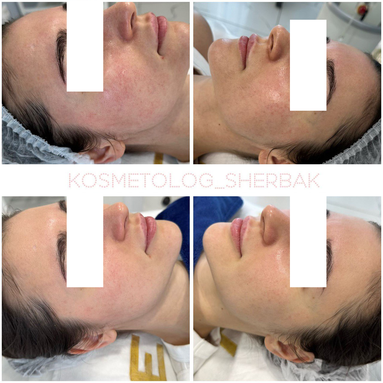 Фотодинамическая терапия (ФДТ) в клинике Прадус