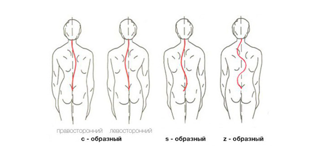 Что такое сколиоз?