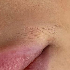 до лазерной эпиляции над губой